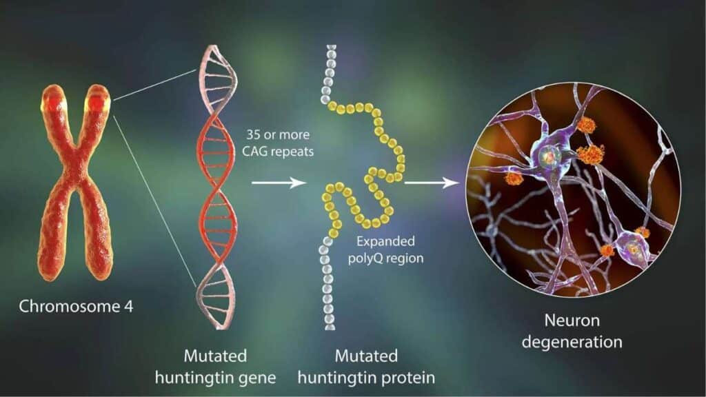 Corea di Huntington - fisiopatologia della malattia