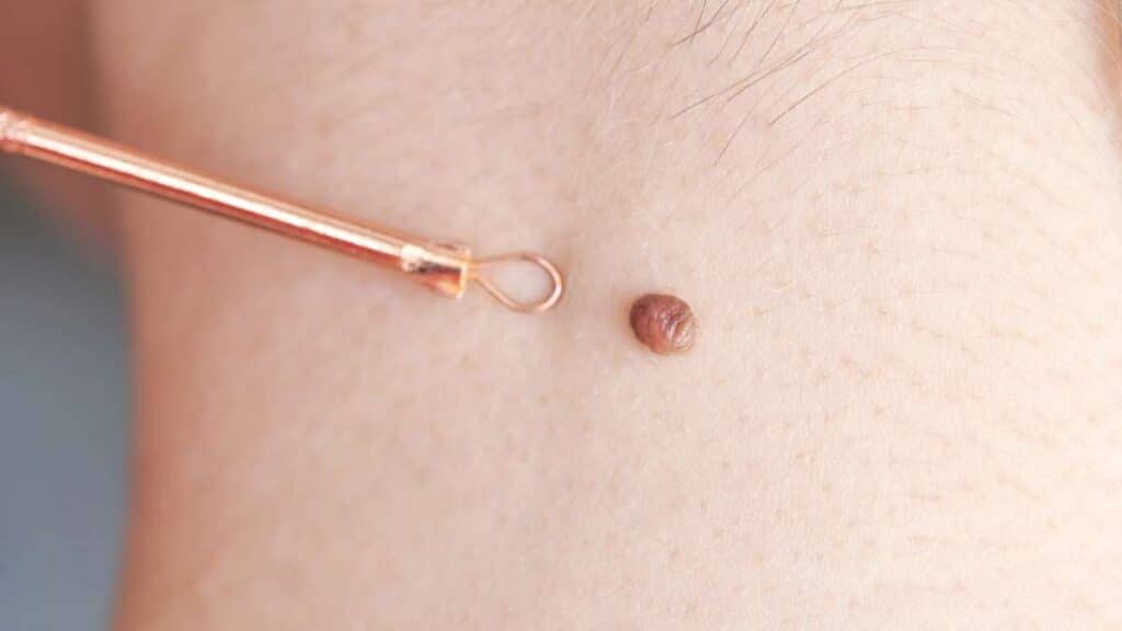 fibroma - tipologie