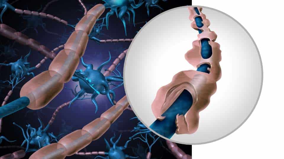 sclerosi multipla - fisiopatologia e forme