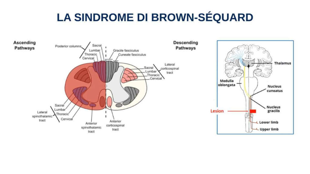 La sindrome di Brown-Séquard - tra storia clinica e neurologia