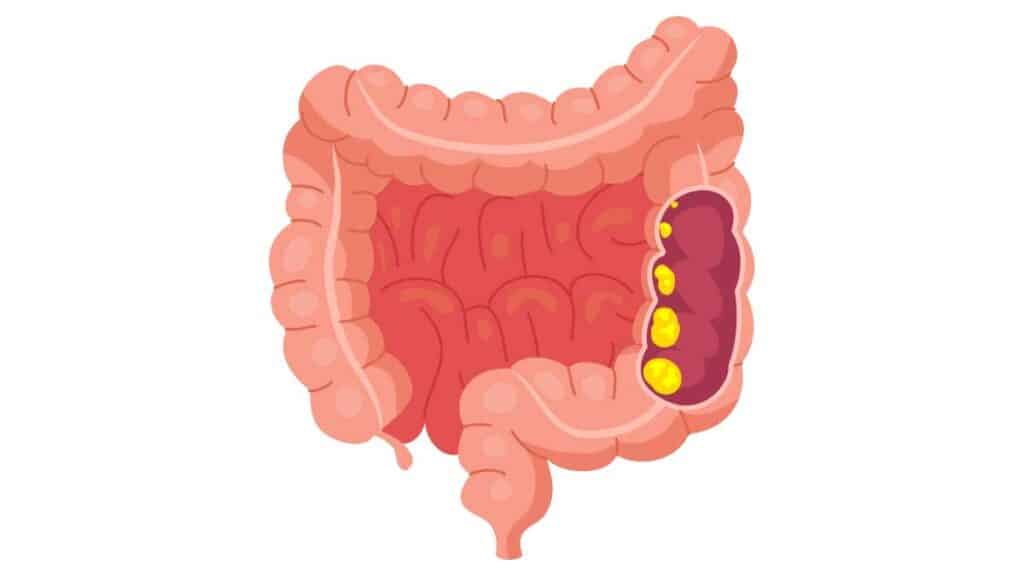 Adenocarcinoma - istologia, tipi e differenze con altri carcinomi