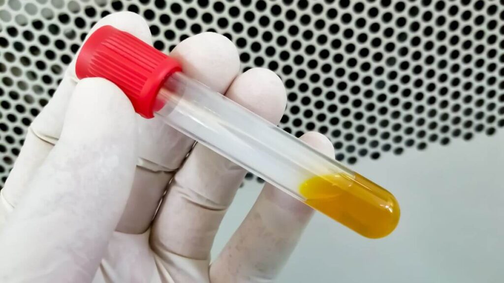 Biochimica della bilirubina - sintesi e metabolismo